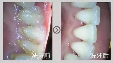 牙齿从根部腐蚀怎么办;牙齿从根部腐蚀怎么办图片