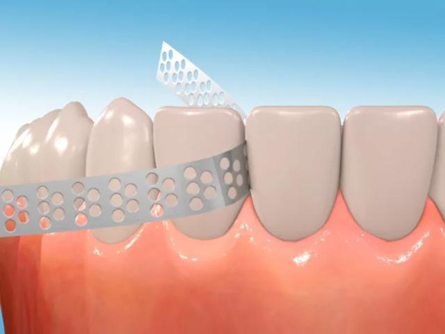 牙齿往外凸怎么办—牙齿往外凸怎么办？(图2)