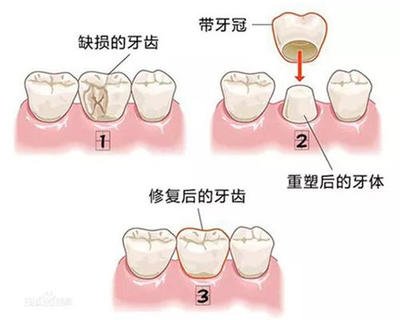 烤瓷牙怎么取下来，烤瓷牙怎么取下来重新做(图2)