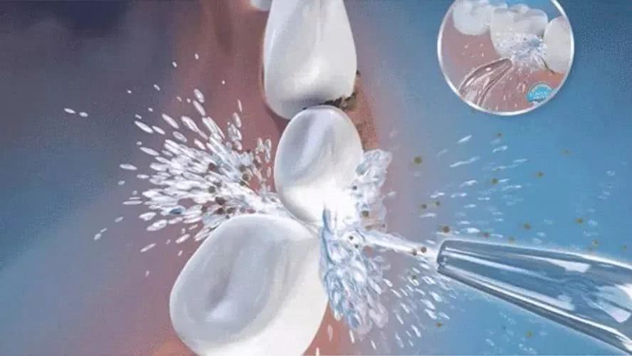 牙结石怎么办—牙结石怎么办较简单方法