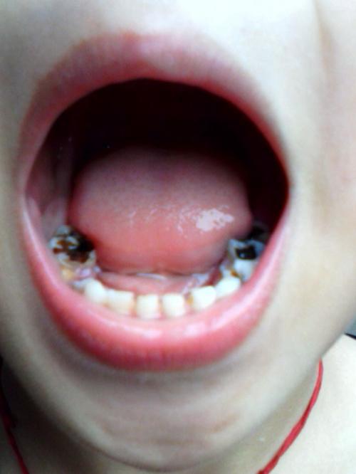 牙釉质磨损怎么修复(牙釉质磨损怎么修复多少钱)(图2)