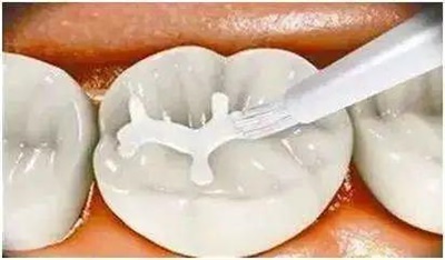 龋齿牙疼怎么办;龋齿牙疼怎么办一招教你3秒止痛