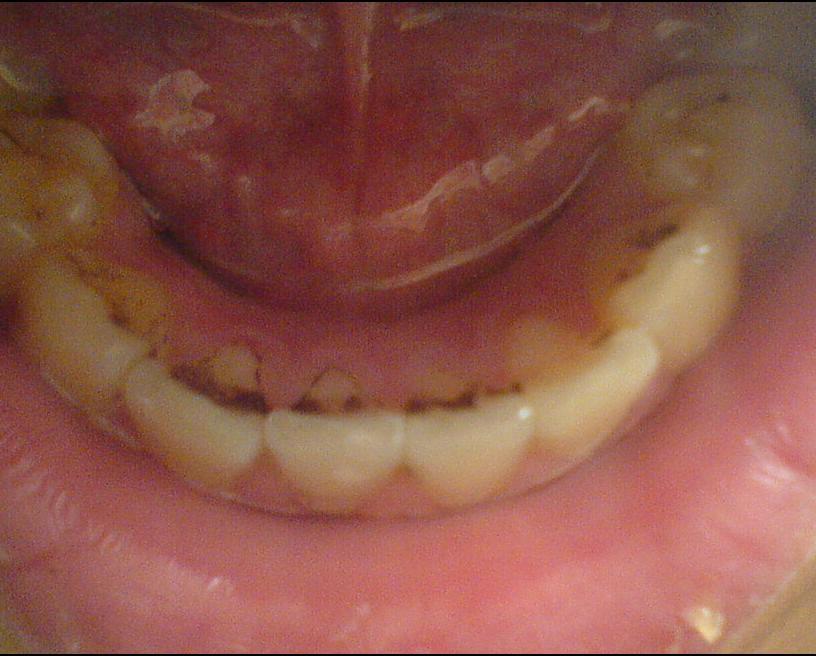 牙齿疼怎么快速止疼-牙齿疼怎么快速止疼吃什么药