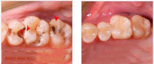 牙齿中间有缝怎么办;50岁牙齿中间有缝怎么办(图2)