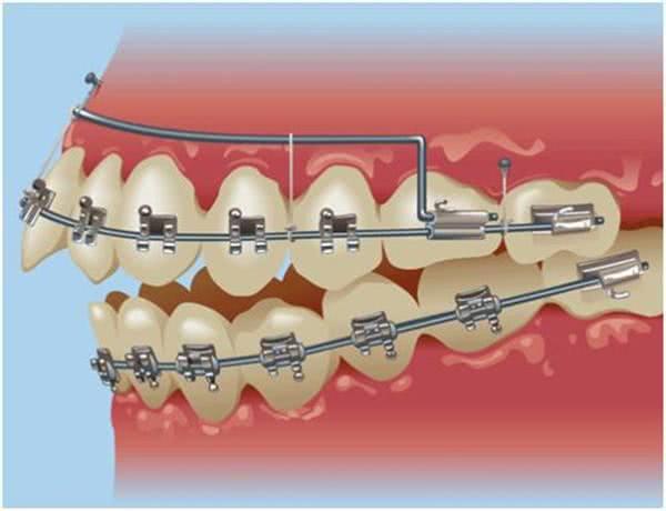 门牙长歪了怎么办，孩子门牙长歪了怎么办