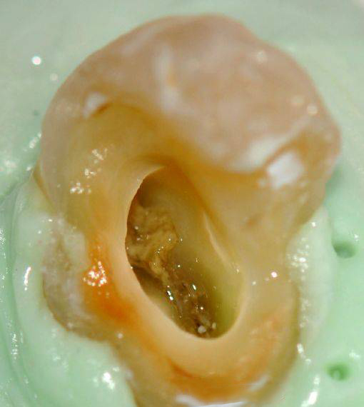 牙齿发炎了怎么办—牙齿发炎了怎么办止疼