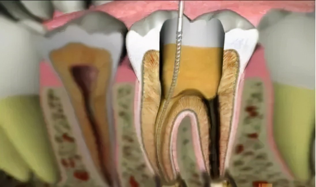 牙疼怎么治疗—牙疼怎么治疗较快止疼方法(图2)