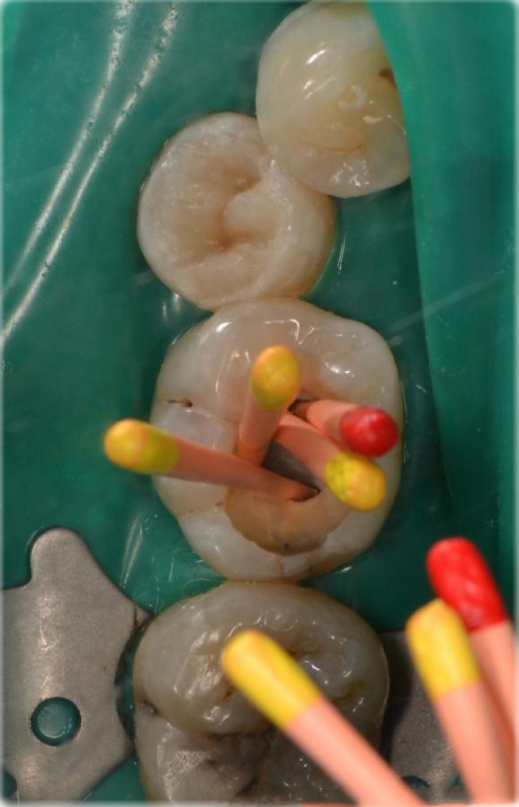 牙齿发炎怎么治疗;牙齿发炎怎么治疗吃盐(图3)