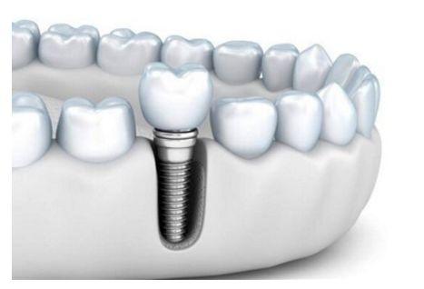 牙隐裂怎么治疗(牙隐裂怎么治疗图片)