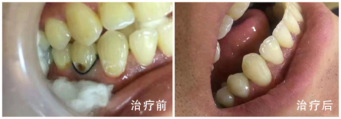 牙石怎么去除—牙石怎么去除较简单的方法