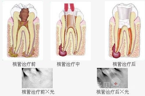 牙晚上疼白天不疼是怎么回事—牙晚上疼白天不疼是怎么回事 牙齿松动
