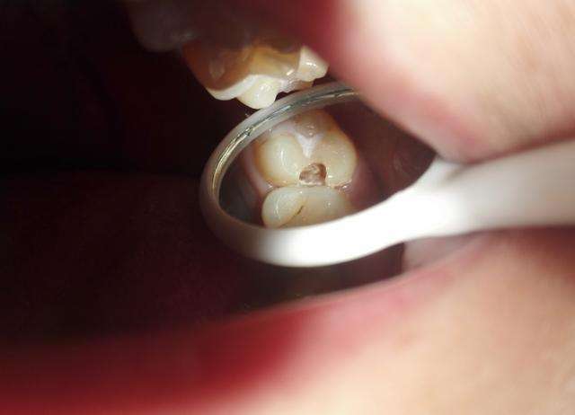 门牙表面有裂纹怎么办(门牙表面有裂纹怎么办啊)