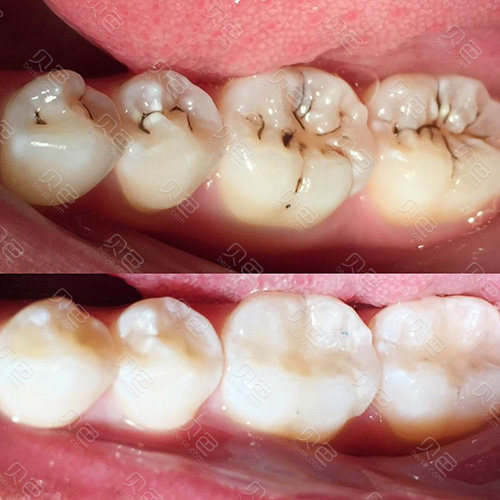 牙突出怎么矫正_牙突出怎么矫正视频(图2)