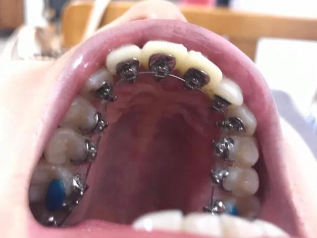 成人牙缝大怎么修复好—成人牙缝大怎么修复好的方法(图2)