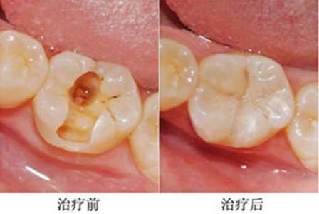 牙齿刷牙酸痛怎么办(牙齿刷牙酸痛怎么办吃什么药)