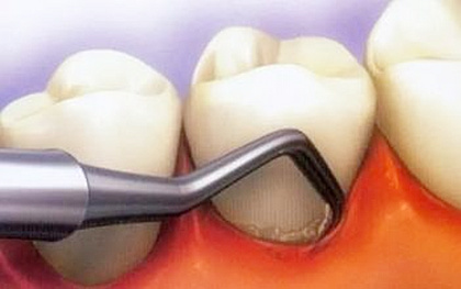 牙周炎怎么治疗与日常保养，牙周炎怎么治疗与日常保养有关