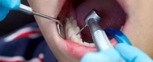 口腔溃疡怎么缓解、口腔溃疡怎么缓解疼痛