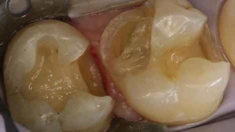 怎么快速缓解牙疼，怎么快速缓解牙疼不用药