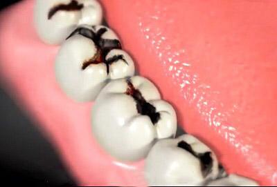 牙齿酸软是怎么回事;牙齿酸软是怎么回事是什么原因