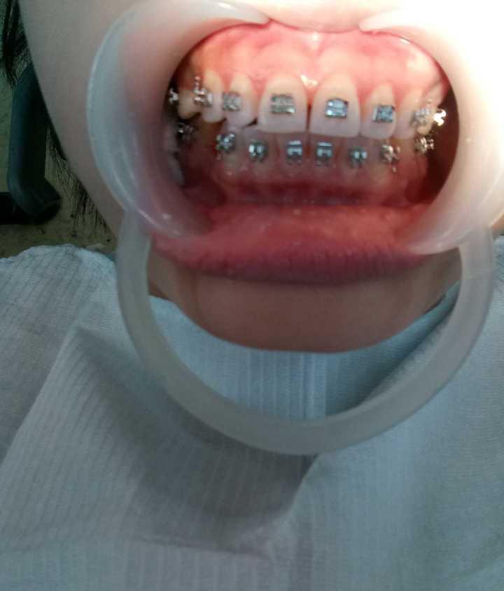 牙齿矫正怎么收费(牙齿矫正怎么收费是不是快速交清)(图2)