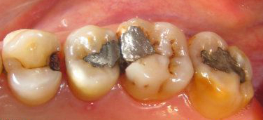 牙疼怎么缓解疼痛，怀孕牙疼怎么缓解疼痛