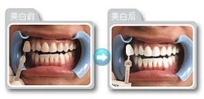 牙烟渍怎么去除、牙烟渍怎么去除小妙招(图3)