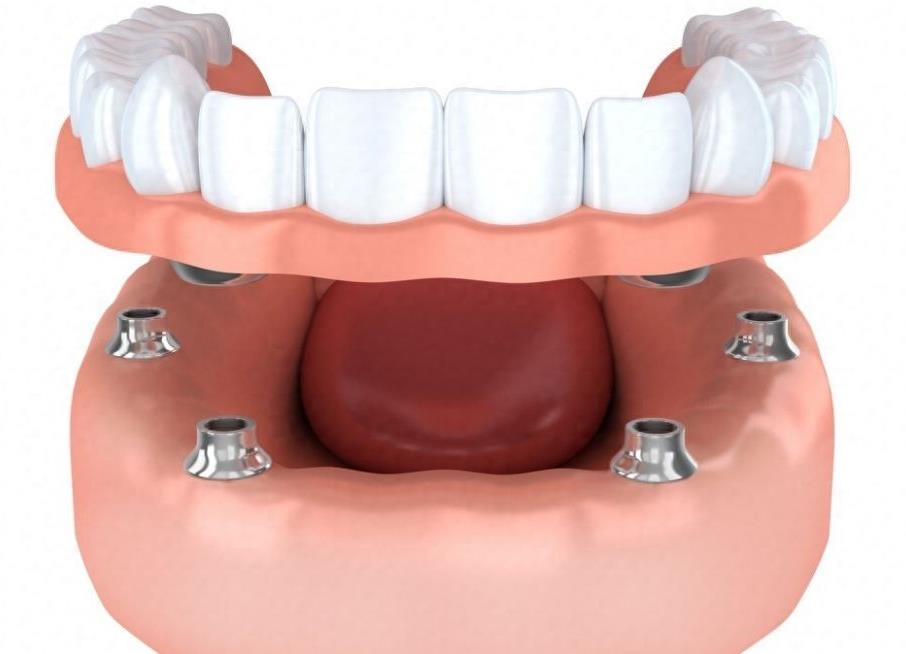 北京钛植口腔医院种植牙攻略：技术、服务与价格解析(图1)