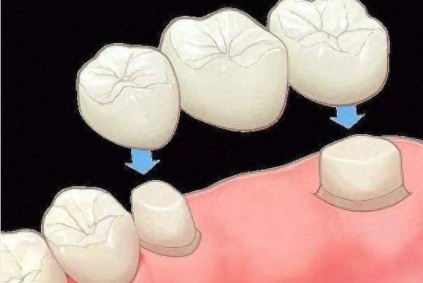 牙齿种植体哪家好?公布一份口碑排名榜名单请查收(图2)