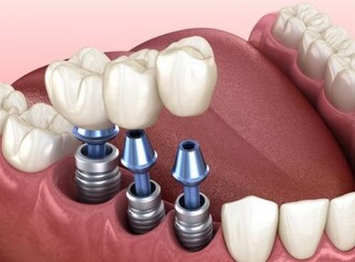 浙江秀洲区种植牙价格详解及选择指南(图2)