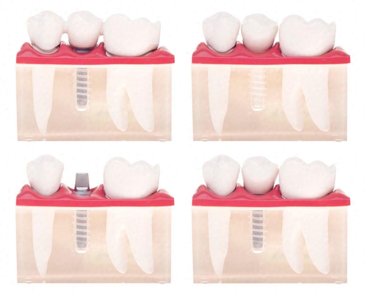 南宁贝美口腔种植牙技术与价格解析(图1)