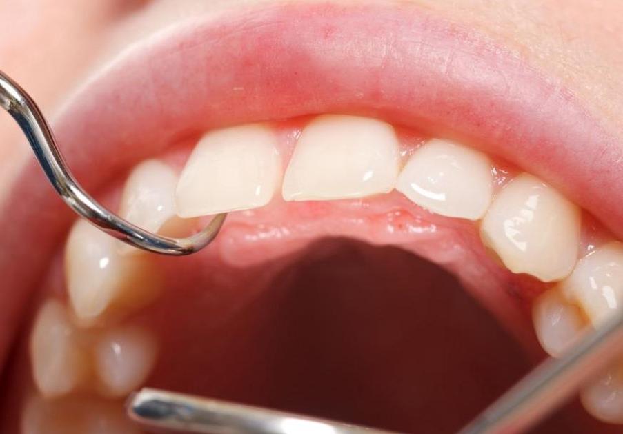 河源地区种植牙价格及优质牙科机构全攻略(图2)