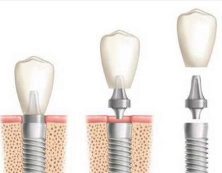 巢湖种植牙价格全解析:集采政策下的市场新趋势(图1)