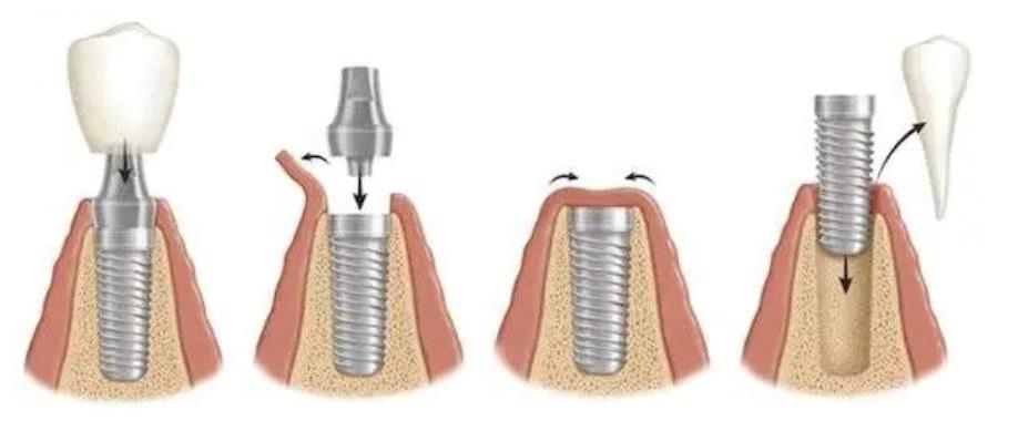 黄石乐芽口腔医院种植牙服务解析：资质、技术与价格全攻略(图2)