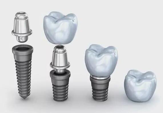 种植牙市场深度解析：价格、品牌与技术概览(图2)