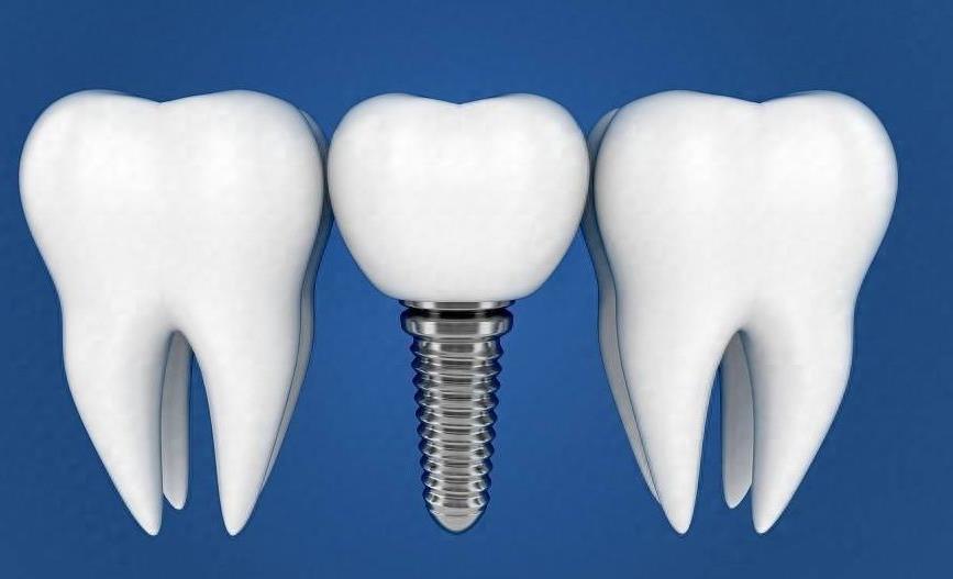 中山香山口腔医院种植牙价格全解析,正规机构收费标准一览(图1)