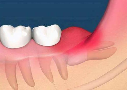 广州牙周治疗费用全解析：不同程度牙周病的花费概览(图1)