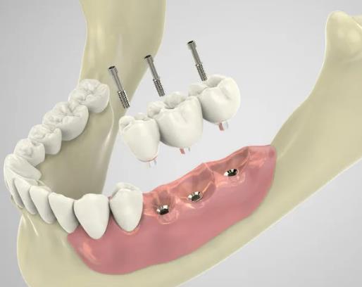 杭州植成口腔:种植牙技术与亲民价格的好结合(图1)