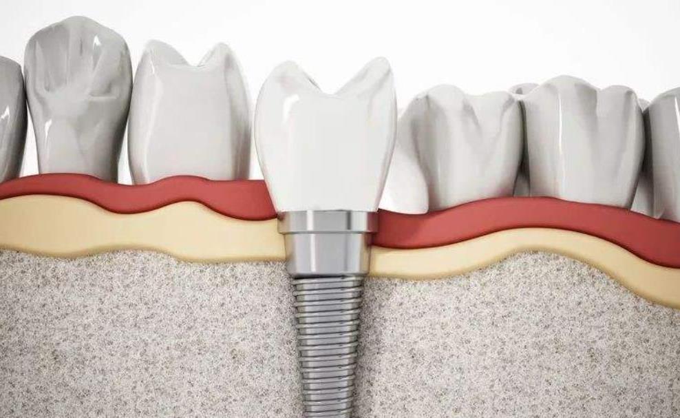 青岛莱恩口腔医院种植牙服务:价格透明,技术先进,让您笑容更自信(图2)