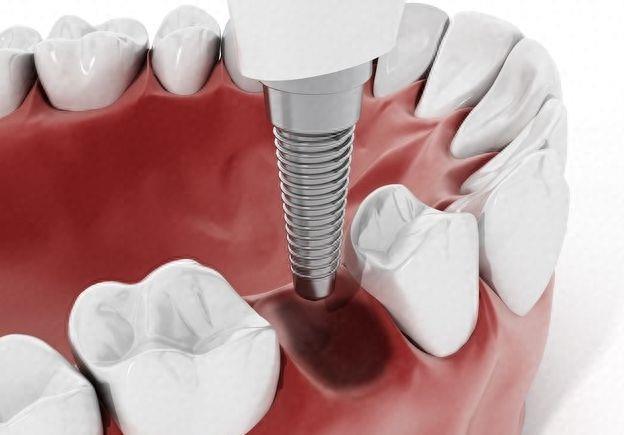 合肥新安口腔医院种植牙价格全解析，种牙经济实惠之选(图2)