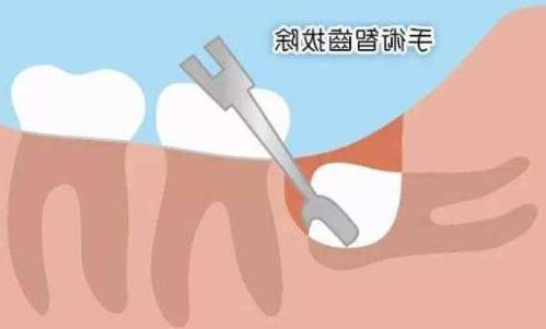 牙齿修复价格全解析:全瓷牙、烤瓷牙与种植牙的比较(图1)
