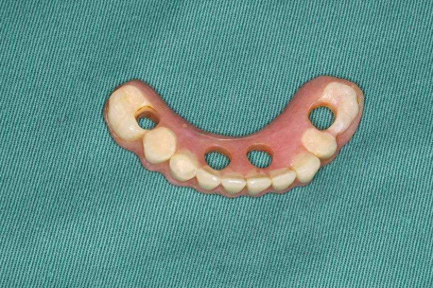 银川种植牙服务哪家强?解析五家口腔医院的种植牙技术与服务(图1)