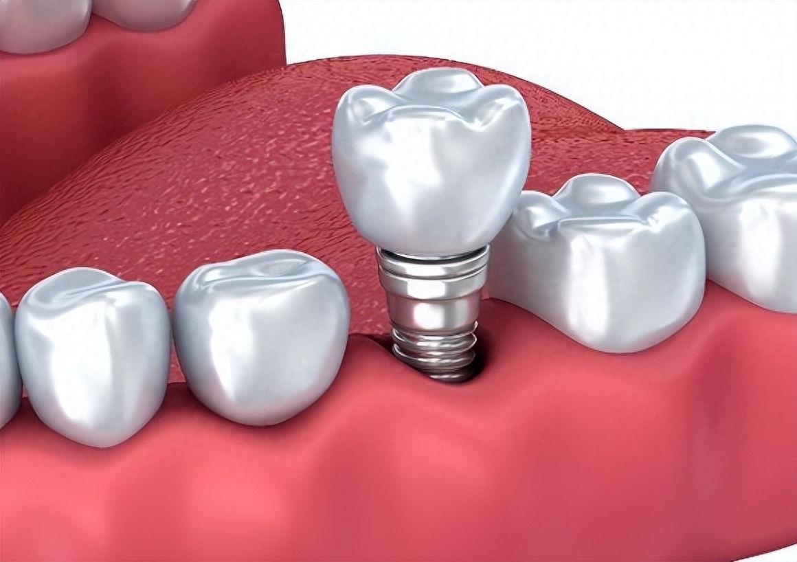 北京地区假牙修复价格全攻略及高性价比牙科诊所推荐(图2)