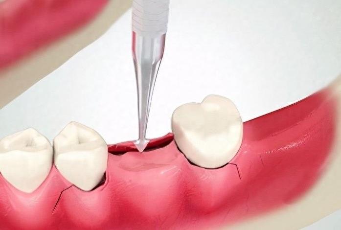 象山地区种植牙技术医院选择指南：丹城与港城医院技术与价格对比分析(图1)