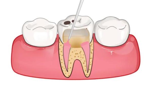 牙齿修复费用详解,经济实惠的镶牙选择指南(图2)