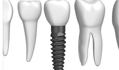 牙齿修复费用解析及疼痛原因分析(图1)