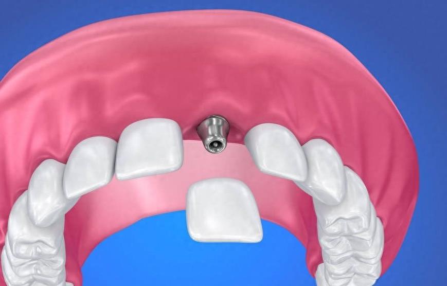 银川牙齿修复费用全解析,儿童与成人补牙价格一览(图1)