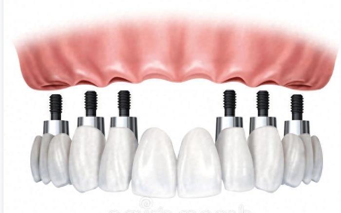 东莞好佰年口腔服务价格全解析:种牙、矫正、洗牙等项目价格亲民(图2)