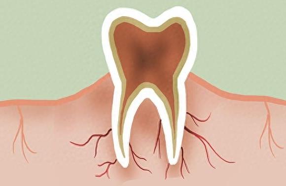 牙齿矫正全新价格指南:解析各类牙套费用(图2)