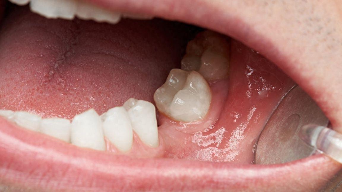 佛山禅医口腔种牙价格全解析，透明化收费标准一览