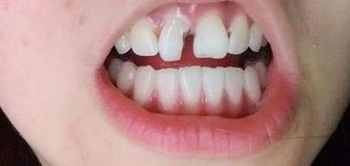 福州深龋齿修复全攻略:价格解析与材料选择指南(图1)